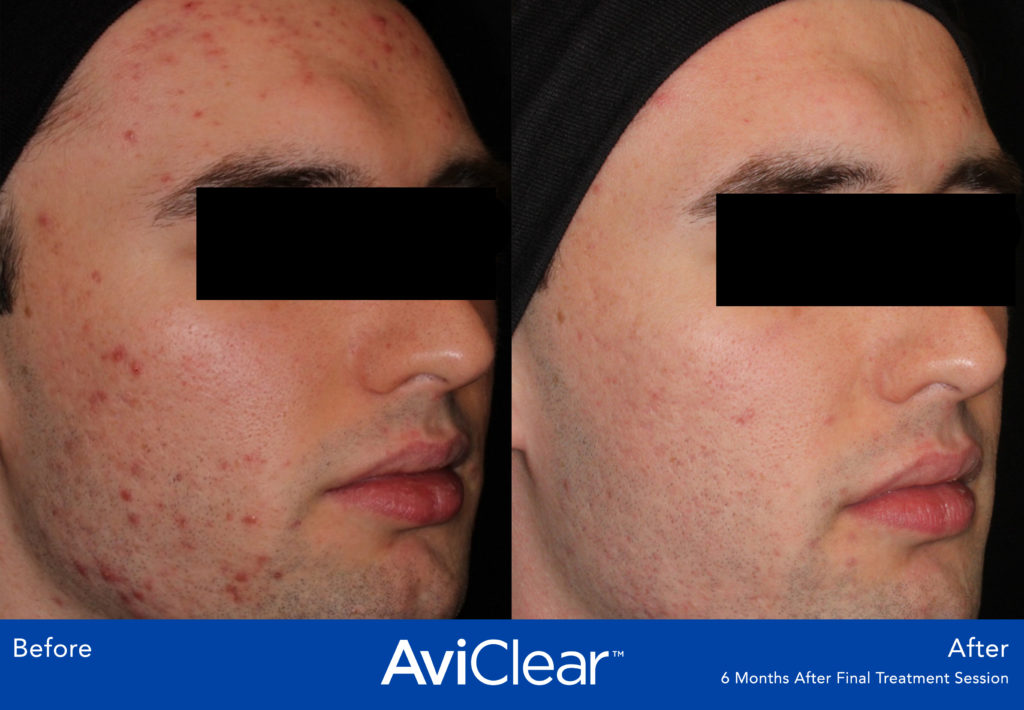 aviclear before and after