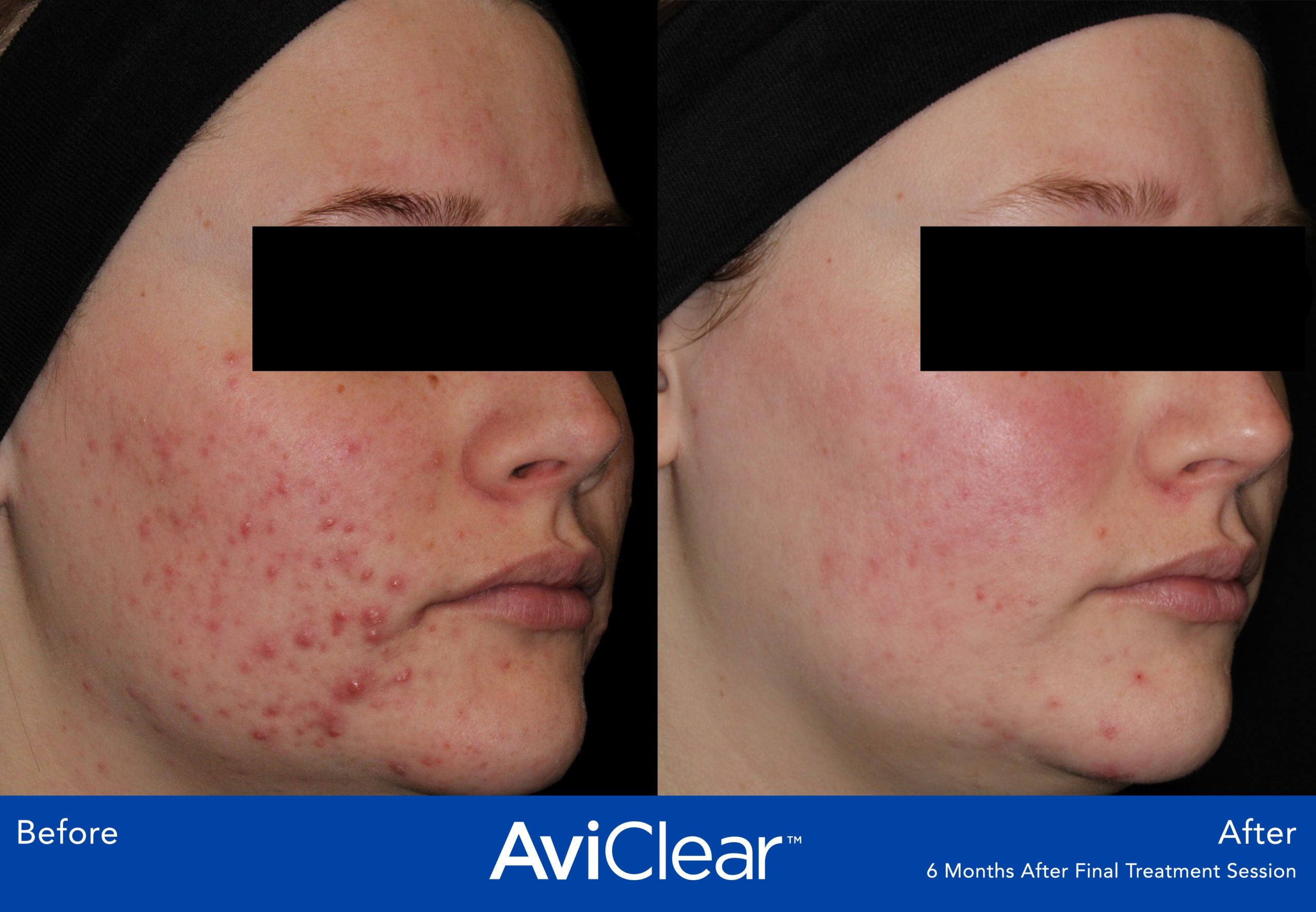 AviClear Before After Photos VITAHL Chicago